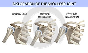 Dislocation of the shoulder joint, medical vector illustration photo