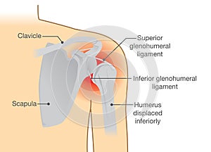 Dislocation Shoulder symptoms or separated.