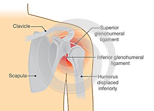 Dislocation Shoulder symptoms or separated. photo