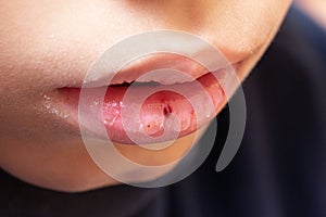Disorders and diseases of the lips in young subjects: how to prevent labial dryness photo