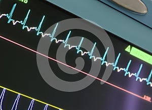 Display with ECG-curve