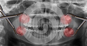 Display four wisdom teeth over x-ray