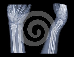 Distal arm fracture