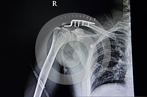 distal clavicle fracture and pulmonary tuberculosis photo