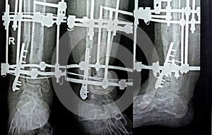 Distal comminuted fracture fibula managed by plate and screws, distal tibia managed by external ring fixator ILIZAROV frame with