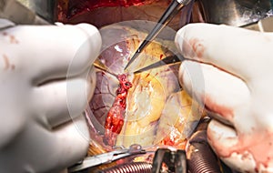 Distal coronary anastomosis with mammary graft photo