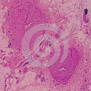 Distal femur (biopsy). Exostosis. Section show mature hyaline cartilage with overlying fibrous perichondrium. photo