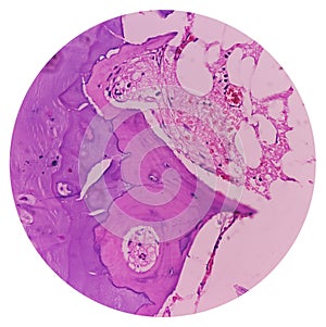 Distal femur (biopsy). Exostosis. Section show mature hyaline cartilage with overlying fibrous perichondrium. photo