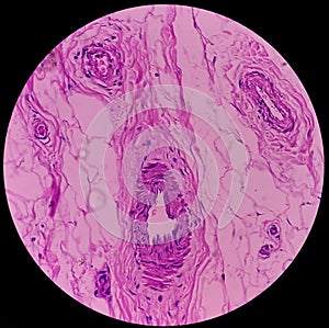 Distal femur (biopsy) : Exostosis. Section show mature hyaline cartilage with overlying fibrous perichondrium. photo