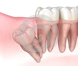 Distal impaction of Wisdom tooth. Medically accurate tooth 3D illustration