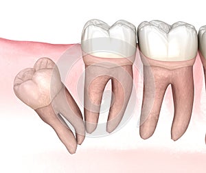 Distal impaction of Wisdom tooth. Medically accurate tooth 3D illustration