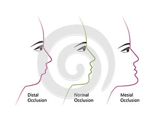 Distal, Normal, and Mesial bite profile, vector illustration. Overbite or underbite before and after orthodontic