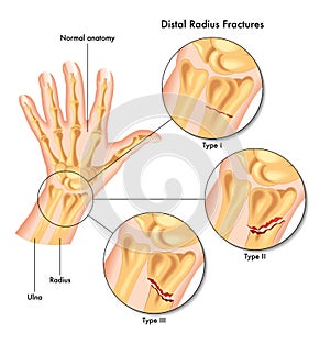 Radio fracturas 