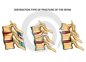 Distraction type of fracture of the spine