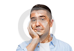 Unhappy sad man with vitiligo photo