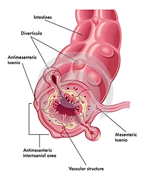 Diverticula