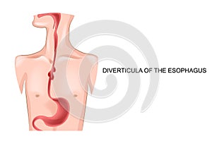 Diverticula of the esophagus
