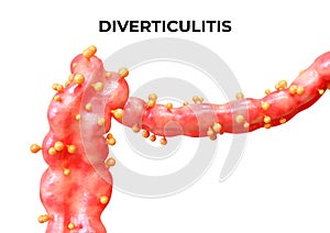 Diverticulitis is a disease that occurs when the diverticula of the large intestine become inflamed or infected, and may present