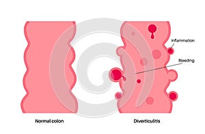 Diverticulitis and diverticulosis