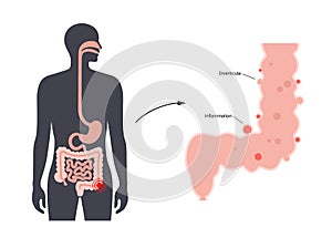 Diverticulitis and diverticulosis