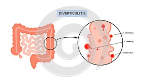 Diverticulitis and diverticulosis