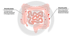 Diverticulitis and diverticulosis