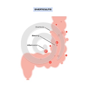 Diverticulitis and diverticulosis photo