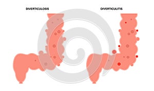 Diverticulitis and diverticulosis photo
