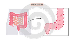 Diverticulitis and diverticulosis photo