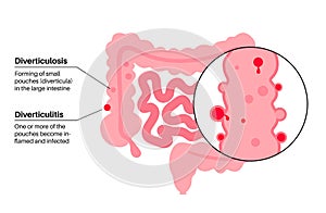 Diverticulitis and diverticulosis photo