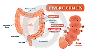 Diverticulitis vector illustration. Labeled diagram with its structure photo