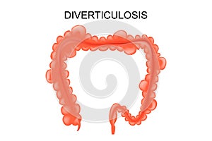 Diverticulosis of the colon