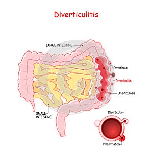 Diverticulosis and Diverticulitis photo