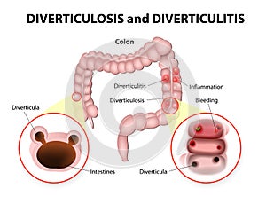 Diverticulosis and Diverticulitis