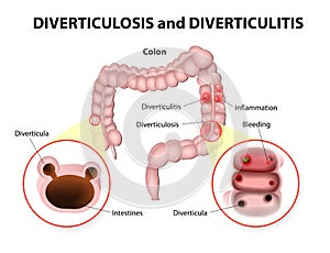 Diverticulosis and Diverticulitis photo