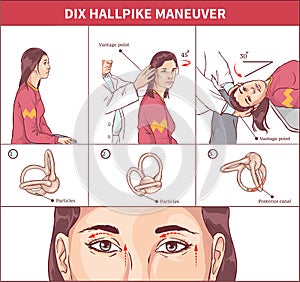 Dix Hallpike Maneuver Vector illustration photo