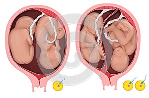 Dizygotic and monozygotic twins photo