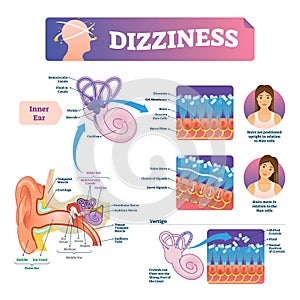 Dizziness vector illustration. Labeled scheme with inner ear and vertigo. photo