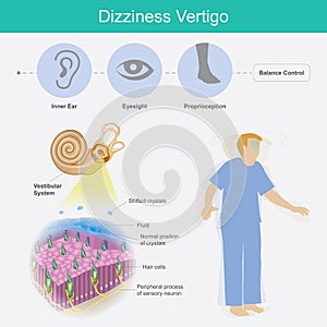 Dizziness Vertigo. Illustration explain dizziness vertigo by cause of crystals can float into the wrong part of the inner ear photo