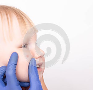 Doctor allergist examines a red pimple on the face of a little girl`s child for the presence of an allergy to sweets, copy space,