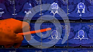 Doctor analyzes the results of computer tomography or CT imaging of patient spine with chronic back pain, shows degenerative