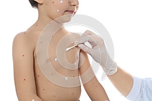 Doctor applying cream onto skin of little boy with chickenpox against white background. Varicella zoster virus