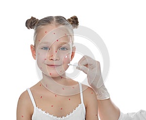 Doctor applying cream onto skin of little girl with chickenpox against background. Varicella zoster virus