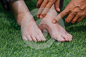 Doctor assessing a elderly swollen foot