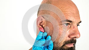 doctor with blue gloves examining an abscess with pus on a swollen and inflamed ear of a caucasian man
