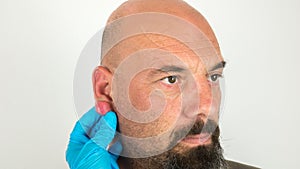 doctor with blue gloves examining an abscess with pus on a swollen and inflamed ear of a caucasian man
