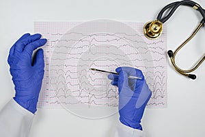 A doctor in blue gloves holds an ECG with rhythm disturbance and extrasystole in his hands.