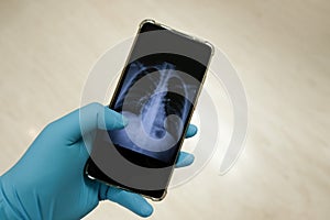 Doctor check patient Chest X-ray film on smartphone