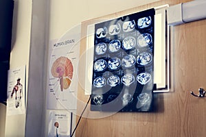 Doctor checking brain x-ray results