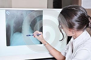 doctor checking chest x-ray image of chest. young brunette woman radiologist pointing on a lung x-ray on a screen. lungs